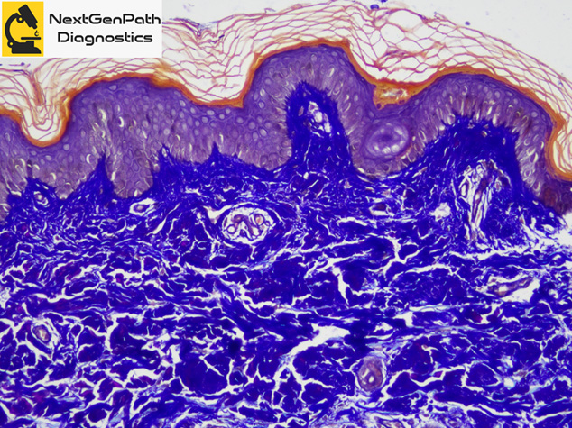 confluent and reticulated papillomatosis pathology